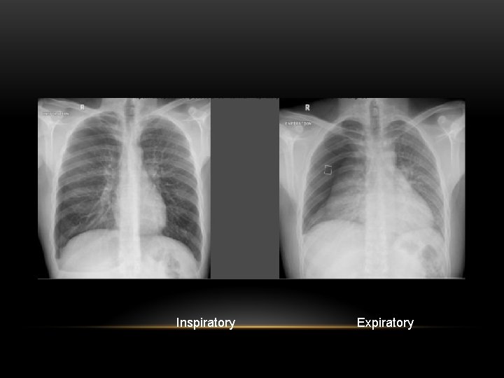 Inspiratory Expiratory 