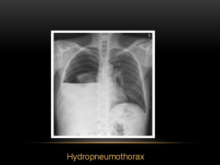 Hydropneumothorax 