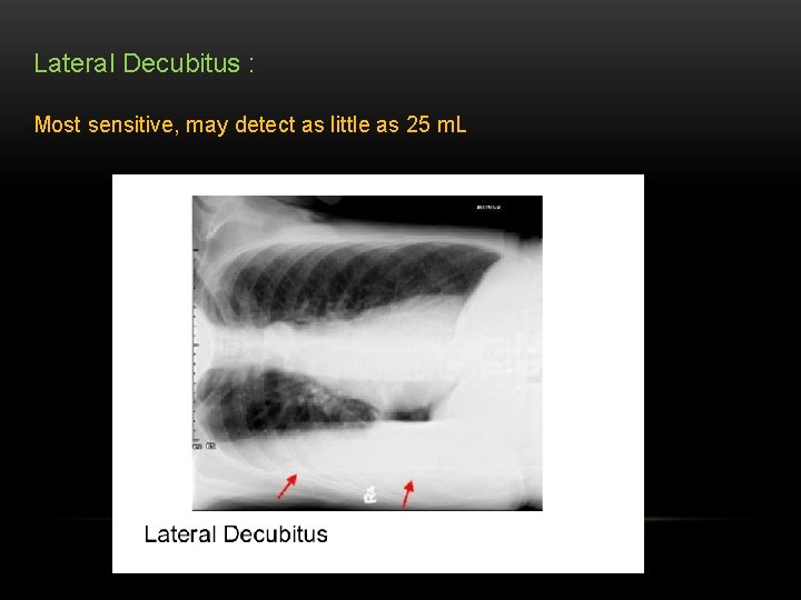 Lateral Decubitus : Most sensitive, may detect as little as 25 m. L 