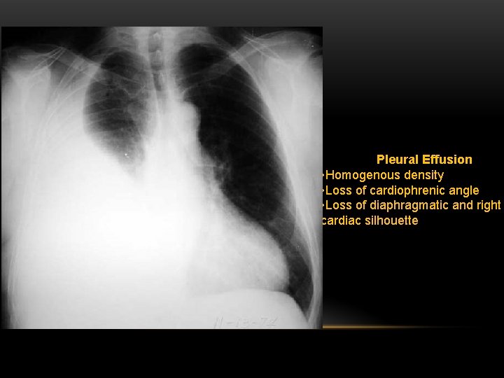 Pleural Effusion • Homogenous density • Loss of cardiophrenic angle • Loss of diaphragmatic