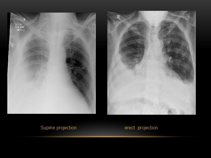 Supine projection erect projection 