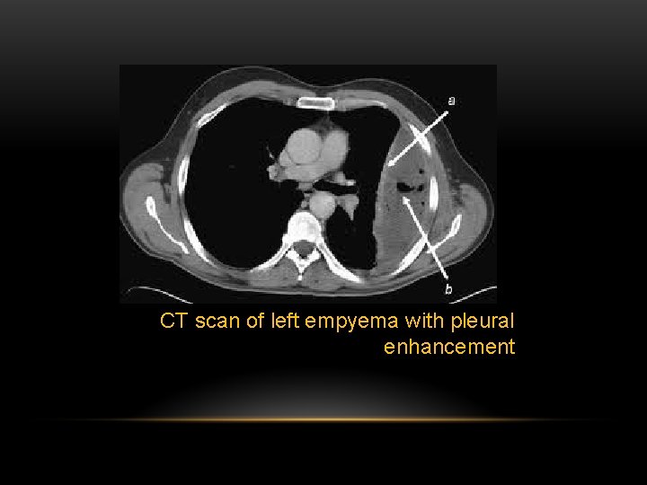 CT scan of left empyema with pleural enhancement 