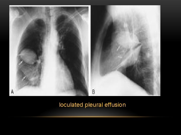loculated pleural effusion 