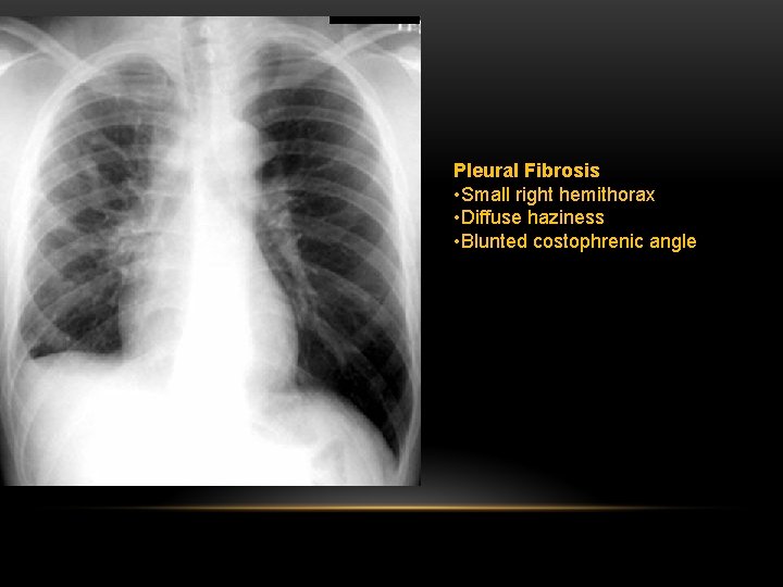 Pleural Fibrosis • Small right hemithorax • Diffuse haziness • Blunted costophrenic angle 