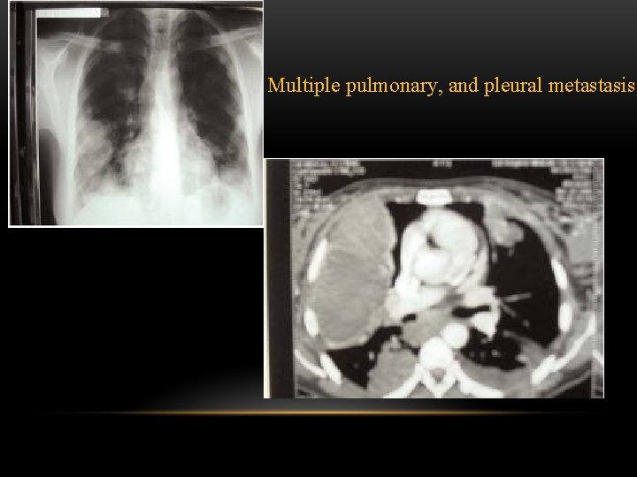 Multiple pulmonary, and pleural metastasis 