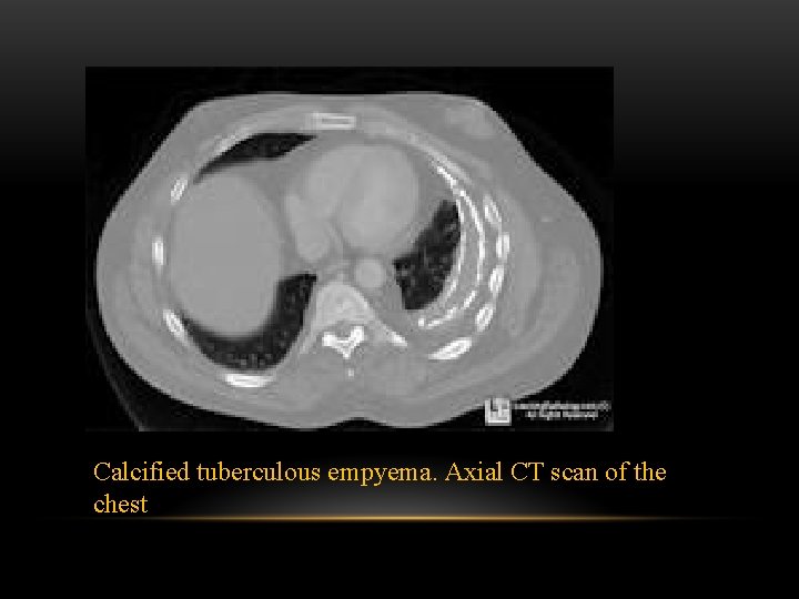 Calcified tuberculous empyema. Axial CT scan of the chest 