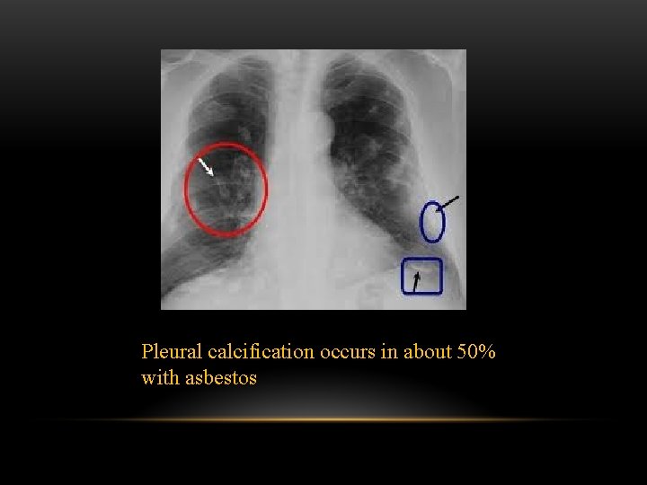 Pleural calcification occurs in about 50% with asbestos 