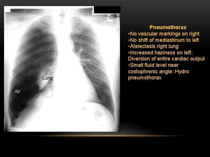 Pneumothorax • No vascular markings on right • No shift of mediastinum to left