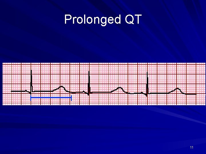 Prolonged QT 11 