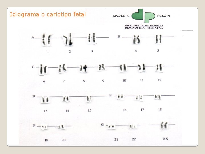 Idiograma o cariotipo fetal 