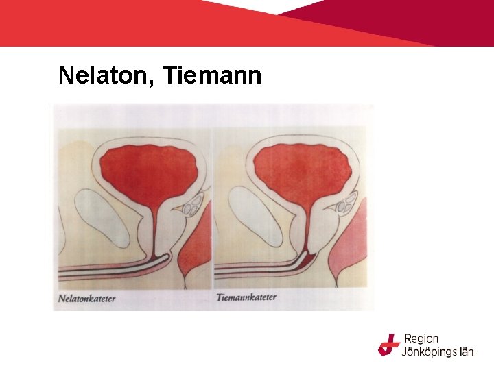 Nelaton, Tiemann 