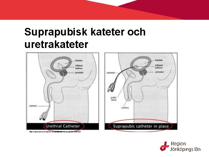 Suprapubisk kateter och uretrakateter https: //gardenrain. wordpress. com/2009/05/14/suprapubic-catheter/ 