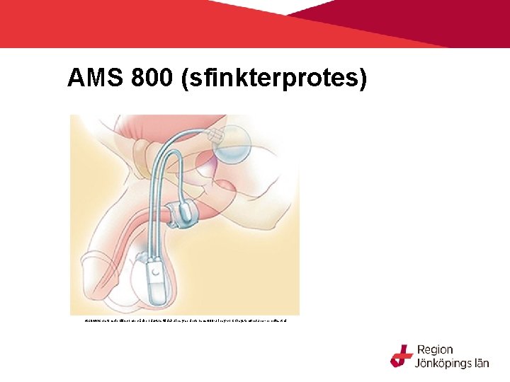 AMS 800 (sfinkterprotes) http: //www. bostonscientific. com/en-EU/products/artificial-urinary-sphincter/ams-800 -urinary-control-system/features--benefits. html 