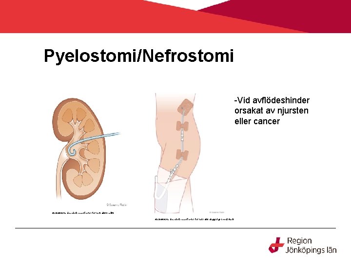 Pyelostomi/Nefrostomi -Vid avflödeshinder orsakat av njursten eller cancer http: //www. vardhandboken. se/Texter/Nefrostomi/Oversikt/ http: //www.