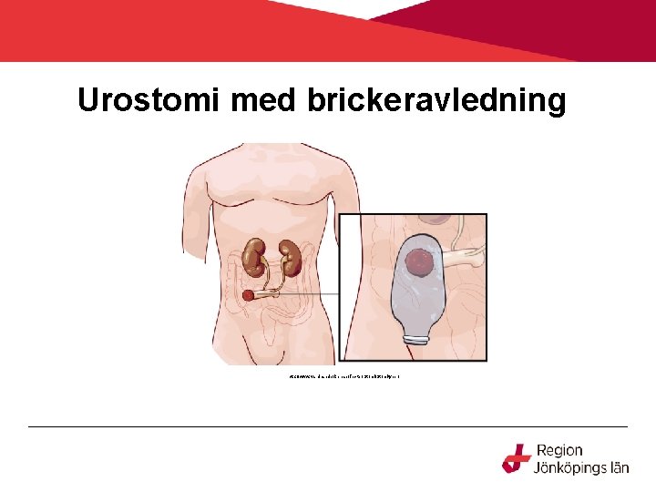 Urostomi med brickeravledning http: //www. vardhandboken. se/Texter/Stomityper/ 