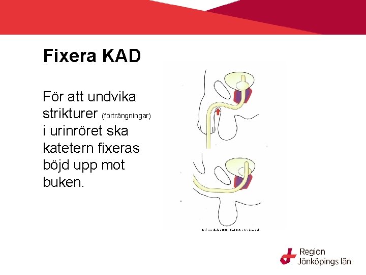 Fixera KAD För att undvika strikturer (förträngningar) i urinröret ska katetern fixeras böjd upp