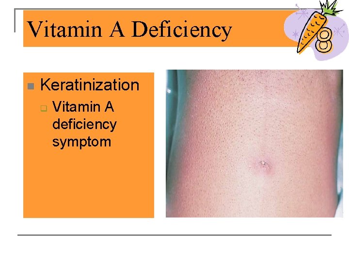Vitamin A Deficiency n Keratinization q Vitamin A deficiency symptom 