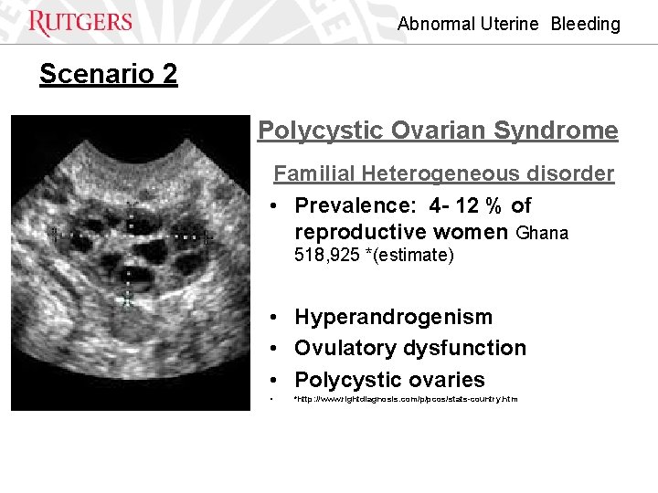 Abnormal Uterine Bleeding Scenario 2 Polycystic Ovarian Syndrome Familial Heterogeneous disorder • Prevalence: 4