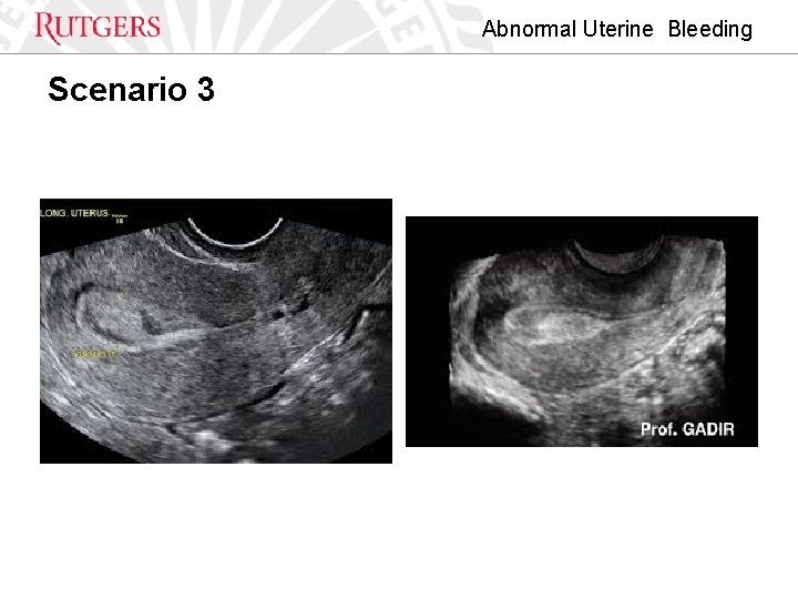Abnormal Uterine Bleeding Scenario 3 