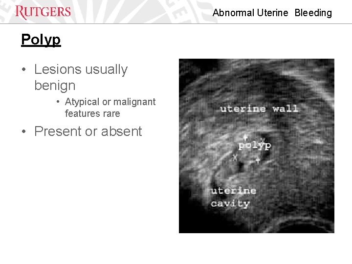 Abnormal Uterine Bleeding Polyp • Lesions usually benign • Atypical or malignant features rare