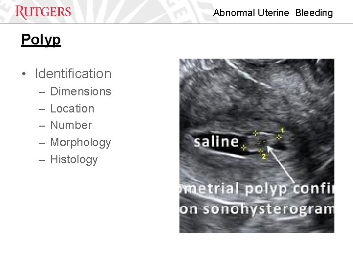 Abnormal Uterine Bleeding Polyp • Identification – – – Dimensions Location Number Morphology Histology