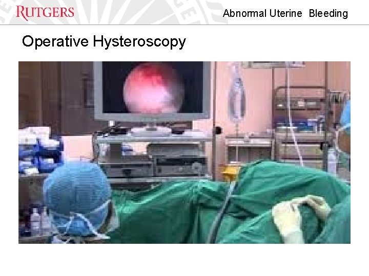 Abnormal Uterine Bleeding Operative Hysteroscopy 