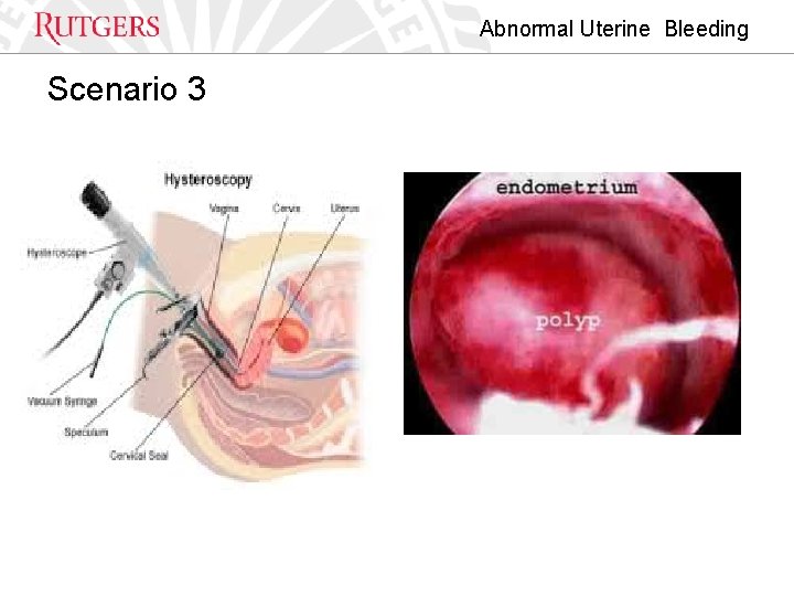 Abnormal Uterine Bleeding Scenario 3 