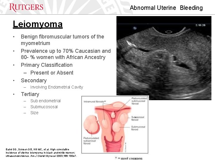 Abnormal Uterine Bleeding Leiomyoma • • Benign fibromuscular tumors of the myometrium Prevalence up