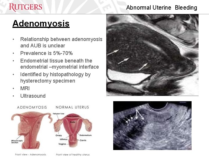 Abnormal Uterine Bleeding Adenomyosis • • • Relationship between adenomyosis and AUB is unclear