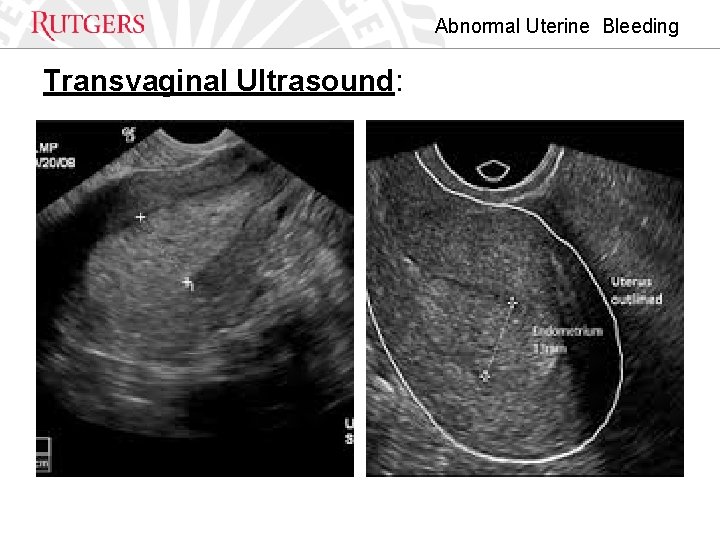 Abnormal Uterine Bleeding Transvaginal Ultrasound: 