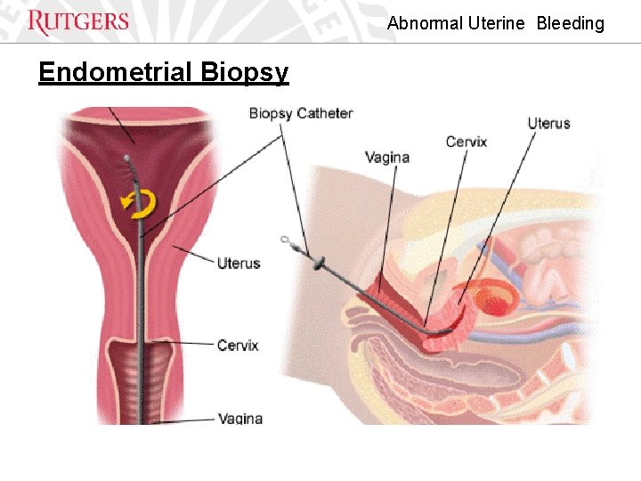 Abnormal Uterine Bleeding Endometrial Biopsy 