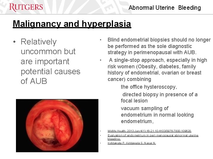 Abnormal Uterine Bleeding Malignancy and hyperplasia • Relatively uncommon but are important potential causes