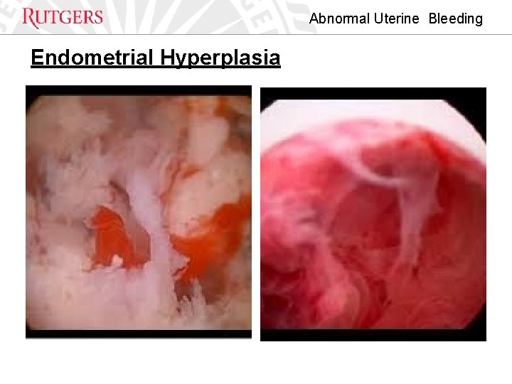 Abnormal Uterine Bleeding Endometrial Hyperplasia 