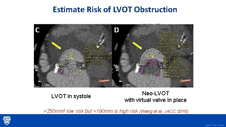 Estimate Risk of LVOT Obstruction LVOT in systole Neo-LVOT with virtual valve in place