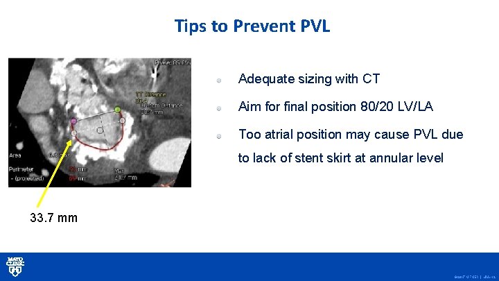 Tips to Prevent PVL Adequate sizing with CT Aim for final position 80/20 LV/LA