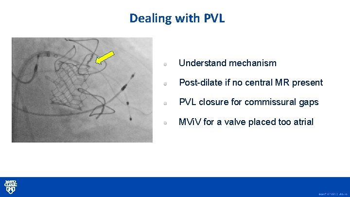 Dealing with PVL Understand mechanism Post-dilate if no central MR present PVL closure for