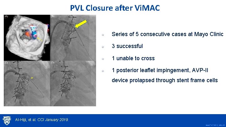 PVL Closure after Vi. MAC Series of 5 consecutive cases at Mayo Clinic 3