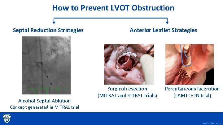 How to Prevent LVOT Obstruction Septal Reduction Strategies Alcohol Septal Ablation Anterior Leaflet Strategies