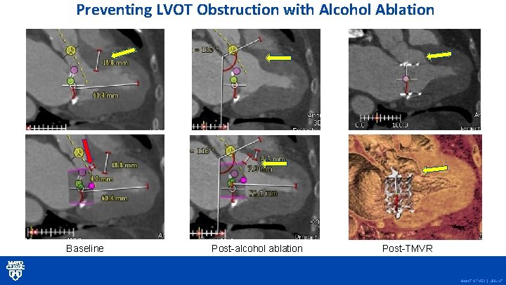 Preventing LVOT Obstruction with Alcohol Ablation Baseline Post-alcohol ablation Post-TMVR © 2017 MFMER |