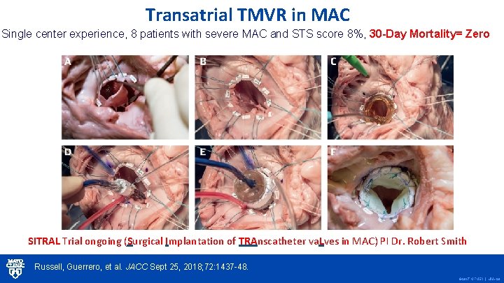 Transatrial TMVR in MAC Single center experience, 8 patients with severe MAC and STS