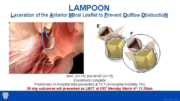 LAMPOON Laceration of the Anterior Mitral Leaflet to Prevent Outflow Obstructio. N MAC (n=15)