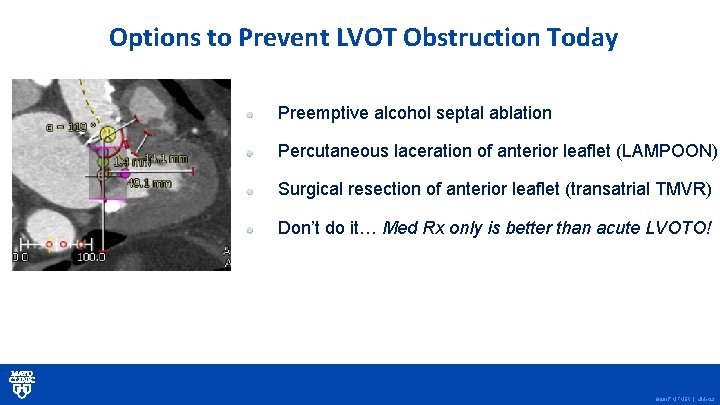 Options to Prevent LVOT Obstruction Today Preemptive alcohol septal ablation Percutaneous laceration of anterior