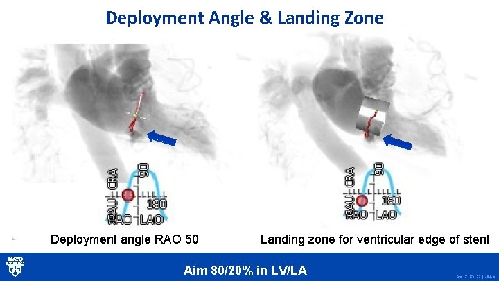 Deployment Angle & Landing Zone Deployment angle RAO 50 Landing zone for ventricular edge