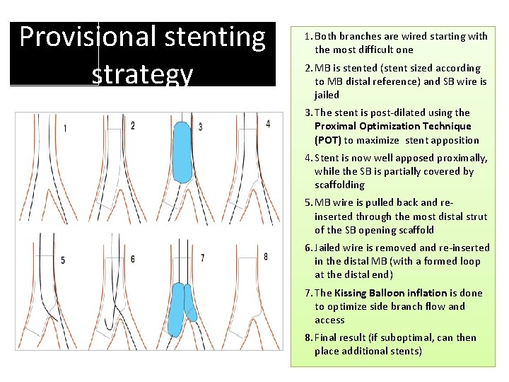 Provisional stenting strategy 1. Both branches are wired starting with the most difficult one