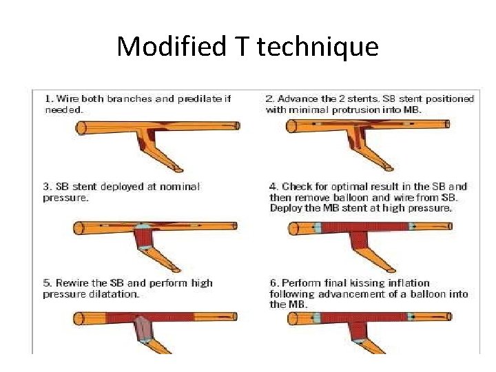 Modified T technique 