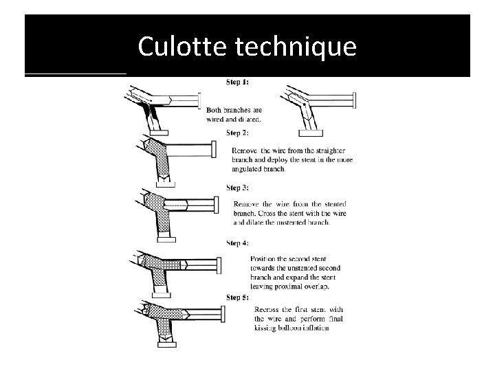 Culotte technique 