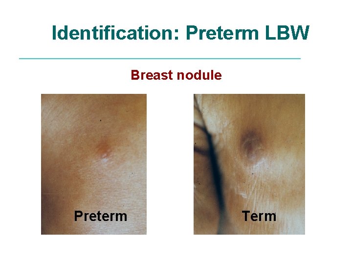 Identification: Preterm LBW Breast nodule Preterm Term 