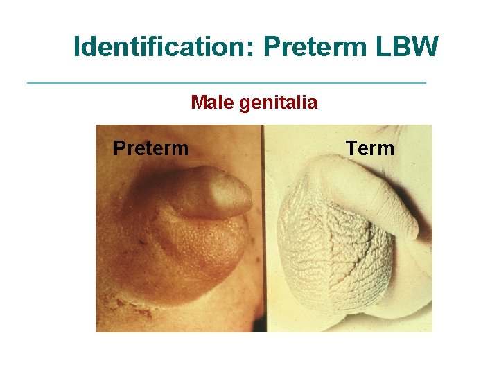 Identification: Preterm LBW Male genitalia Preterm Term 