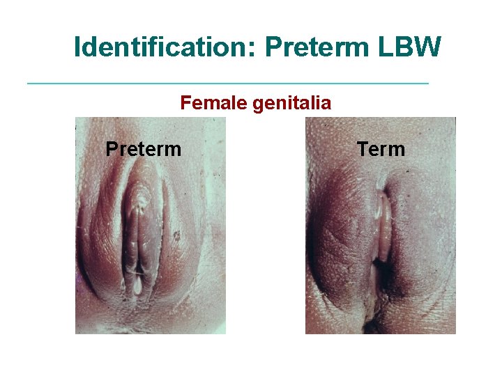 Identification: Preterm LBW Female genitalia Preterm Term 