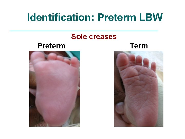 Identification: Preterm LBW Sole creases Preterm Term 